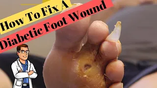 The FAST Diabetic Foot Ulcer Fix! (Type 2 Diabetes +Neuropathy)