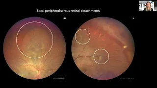 Complex Case in Retina