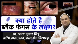 Coronavirus: Mucormycosis(Black Fungus) Symptoms in Hindi |Dr. Abhay Kumar Singh |Sr.ENT Consultant