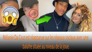 Mélanie Da Cruz : victime de viol.ences conjugales ? Elle est apparue avec une blessure au visage 😨