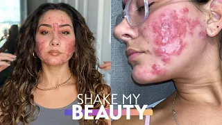 My Cystic Acne Started At 21 | SHAKE MY BEAUTY