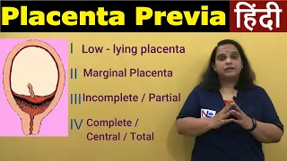 Placenta Previa in Hindi | APH Antepartum Hemorrhage-Types, Risk factors, Symptoms | Nursing Lecture