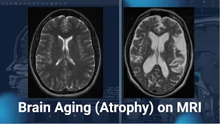 Brain Atrophy on MRI