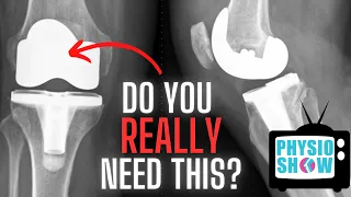 How Do You Know If You Need A Knee Replacement?