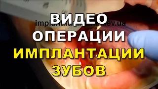 Имплантация зубов Киев (видео) - операция. Стоматология Люми-Дент