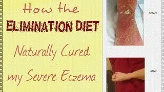 How the Elimination Diet Naturally Cured My Severe Eczema