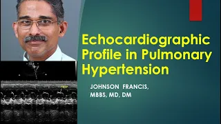 Echocardiographic profile of pulmonary hypertension