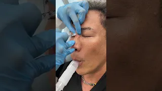 Nonsurgical Nosejob using Hylauronic Acid Fillers by Nurse Ami - Ageless MD