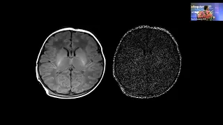 Neuroimaging