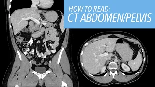 How to Read a CT Abdomen & Pelvis like a Radiologist: Introductory Approach and Basic Search Pattern