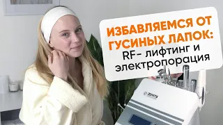 Избавляемся от гусиных лапок: RF-лифтинг и электропорация