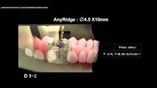 AnyRidge Drilling Guide of 4 5 x 10 in D1 D5 Bone Narrated
