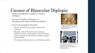 Binocular vs. Monocular Diplopia