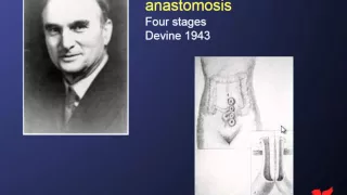 History and development of the ileo-anal J-pouch - Professor Sue Clark, St. Mark's Hospital.