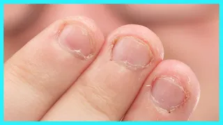 Fix Bitten Nails and Avoid Allergies with My Hack!