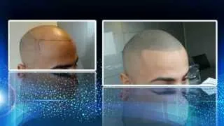 Scalp Micro Hair Pigmentation (SMP) - Tricopigmentation