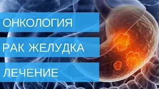 РАК ЖЕЛУДКА лечение 1,2,3,4 стадии