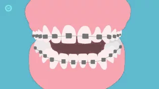 How To Brush Your Teeth With Braces - A Step By Step Guide