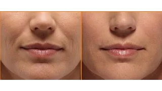 Smooth Out Smile Wrinkles With Face Massage / Laugh Wrinkles / Nasolabial Fold