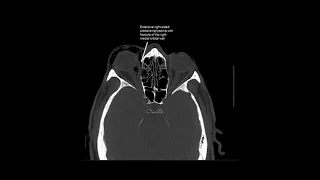 Right Medial Orbital Fracture