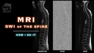 MRI SWI OF THE SPINE – HOW I DO IT