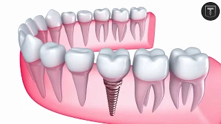 Titanium Dental Implant Surgery 3D Animation