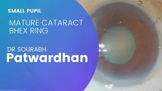 Dr Sourabh Patwardhan Live Cataract surgery. Toric IOL, small pupil,mature cataract