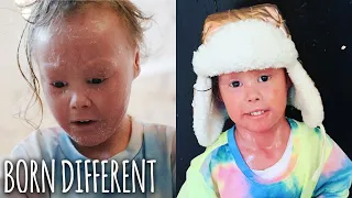 The Girl Whose Skin Grows Too Fast | BORN DIFFERENT