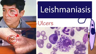 Leishmaniasis - Symptoms and Treatment of Leishmaniasis. Explained under  3 minutes