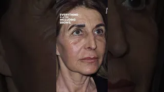 HOW MUCH YOUNGERDOES SHE LOOK? #faceliftsurgery #rhinoplasty #blepharoplasty #surgeryresults