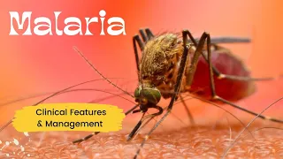 Clinical Features & Management of Malaria