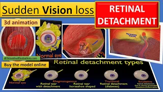 Retinal detachment - retinal detachment types - rhegmatogenous (rrd) - how retinal detachment occurs