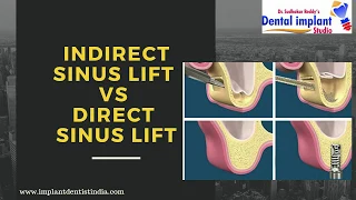 Indirect sinus lift vs Direct sinus lift