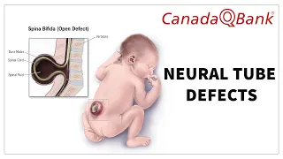 Neural Tube Defects