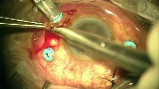 IOFB Foreign body removal using intraocular magnet