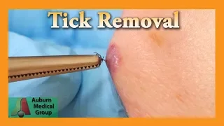 Dead Tick Removal | Auburn Medical Group