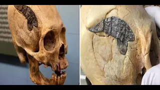 Archaeologists Stunned As 2,000 Year Old Skull Bound By Metal Evidence of Ancient Surgery!
