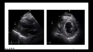 Value of Echo in Cardiogenic shock  Dr. Hatem Soliman MBBS MSc MRCP EDICM  FHEA FEACVI FASE