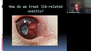 Lecture: Pediatric Uveitis