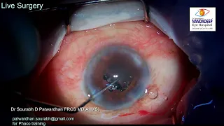 Mature cataract central corneal opacity optical iridectomy Live surgery Dr Sourabh Patwardhan