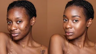 Cover Acne & Dark Marks WITHOUT FOUNDATION | Minimalist Makeup For Acne