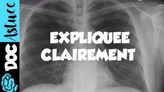 🔴 Dr Astuce - 3 ANOMALIES RADIO THORAX EXPLIQUÉES CLAIREMENT ! (PARTIE 1)