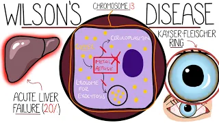 Understanding Wilson's Disease (Hepatolenticular Degeneration)