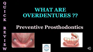 WHAT ARE OVERDENTURES? Preventive Prosthodontics