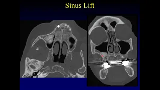 Imaging of the Paranasal Sinuses 5