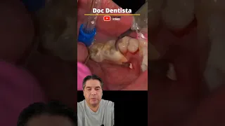 Eliminando Sarro Dental. ASMR  #Shorts