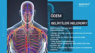 Ödem Nedir? Nasıl Atılır?