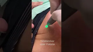 Fotoageing treatment with TimeWalker by Fotona laser