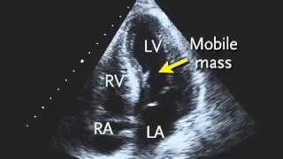 Transthoracic Echocardiogram