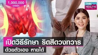 เปิดวิธีรักษา ริดสีดวงทวาร ด้วยตัวเอง หายได้! : TNN Health